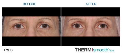 ThermiSmooth® Skin Tightening .